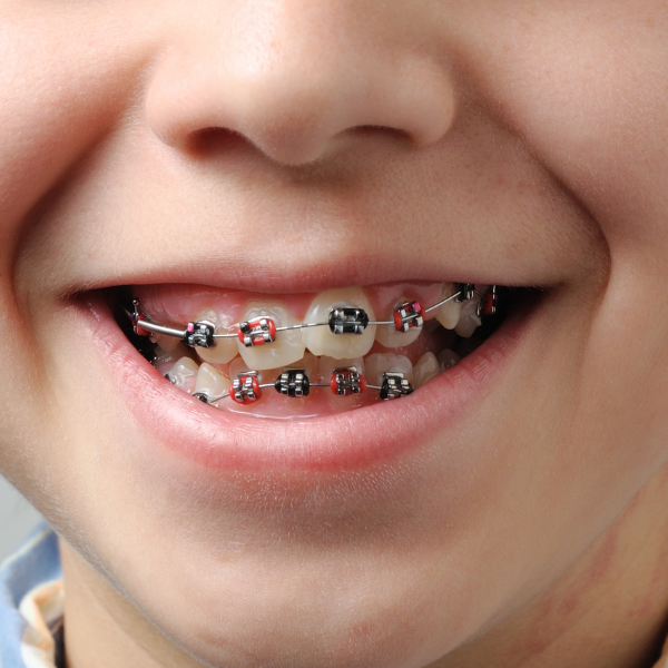 Drs Ngema & Dubula Orthodontist’s Orthodontist near me The best orthodontist Orthodontist in Alberton Orthodontist in Sandton Orthodontist in Midrand Orthodontist in Boksburg Orthodontist in Randburg Orthodontist in Kimberly Orthodontist in Lynnwood Pretoria PTA Orthodontist in Montana Pretoria PTA Orthodontist South Africa Orthodontist Ortho straight teeth straighten teeth braces Before and after braces Drs Ngema & Dubula Orthodontist’s work Drs Ngema & Dubula Orthodontist’s before and after braces before and after braces south africa