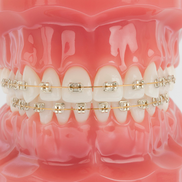 Champagne braces